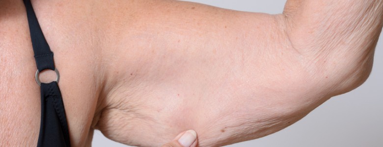 Arm Lift Surgery Perth - Brachioplasty - Sagging Skin