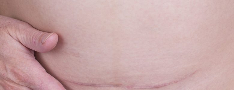 Abdomioplasty perth - scar healing - Timeless Cosmetics